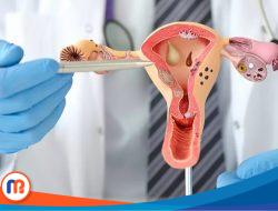 Pakar UNAIR Berikan Edukasi tentang PCOS