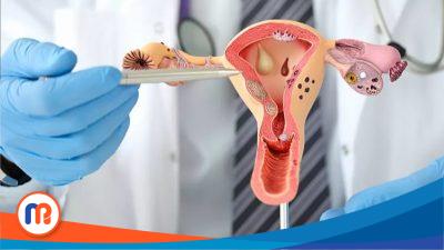 Foto Polycystic Ovarian Syndrome (PCOS) yang sempat viral di Twitter