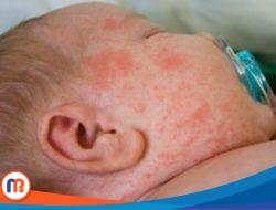 Kasus Campak di Sumenep Tembus 1.944, Belasan Anak Meninggal Dunia